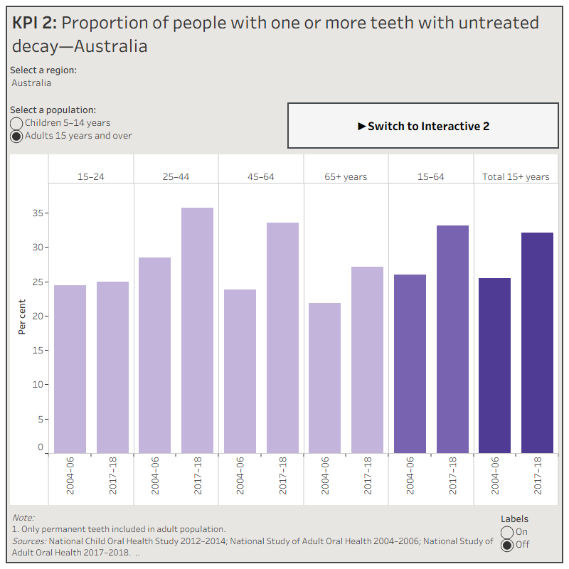 KPI 2 Interactive 1: Proportion of people with one or more teeth with untreated decay—AustraliaThis figure shows the proportion of children aged 5-14 years and adults aged 15 years and over with one or more teeth with untreated decay. National, state and territory data is presented for 2004-06, 2012-14 and 2017-18. In Australia, 26% of children aged 5-14 years had one or more teeth with untreated decay in 2012-14. In Australia, 32% of adults aged 15 years and over had one or more teeth with untreated decay in 2017-18.KPI 2 Interactive 2: Proportion of people with one or more teeth with untreated decay—Public dental clientsThis figure shows the proportion of public dental clients aged 5-14 years, 15-64 years and 65 years and over with one or more teeth with untreated decay, by state and territory, between 2014-15 and 2017-18.
