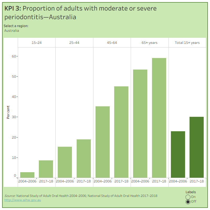 KPI 3: Proportion of adults with moderate or severe periodontitis—AustraliaThis figure shows the proportion of adults aged 15 years and over with moderate or severe periodontitis. National, state and territory data is presented for 2004-06 and 2017-18. In Australia, 30% of adults aged 15 years and over had moderate or severe periodontitis in 2017-18.

